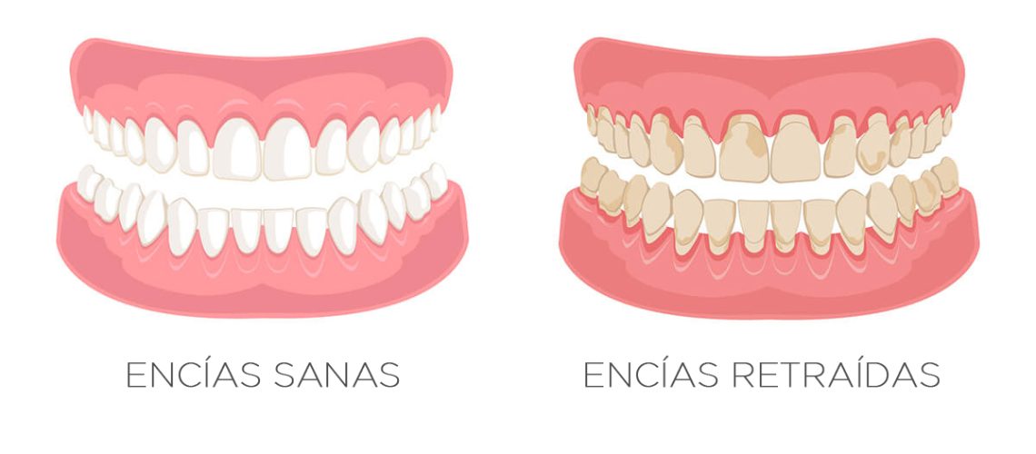 Como_solucionar_las_encias-retraidas