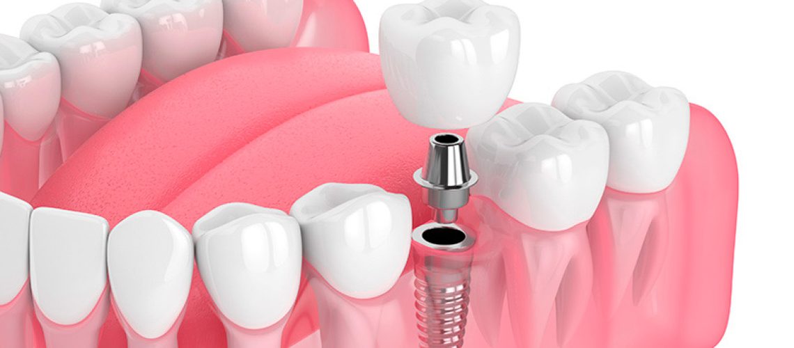 dudas_sobre-implantes-dentales