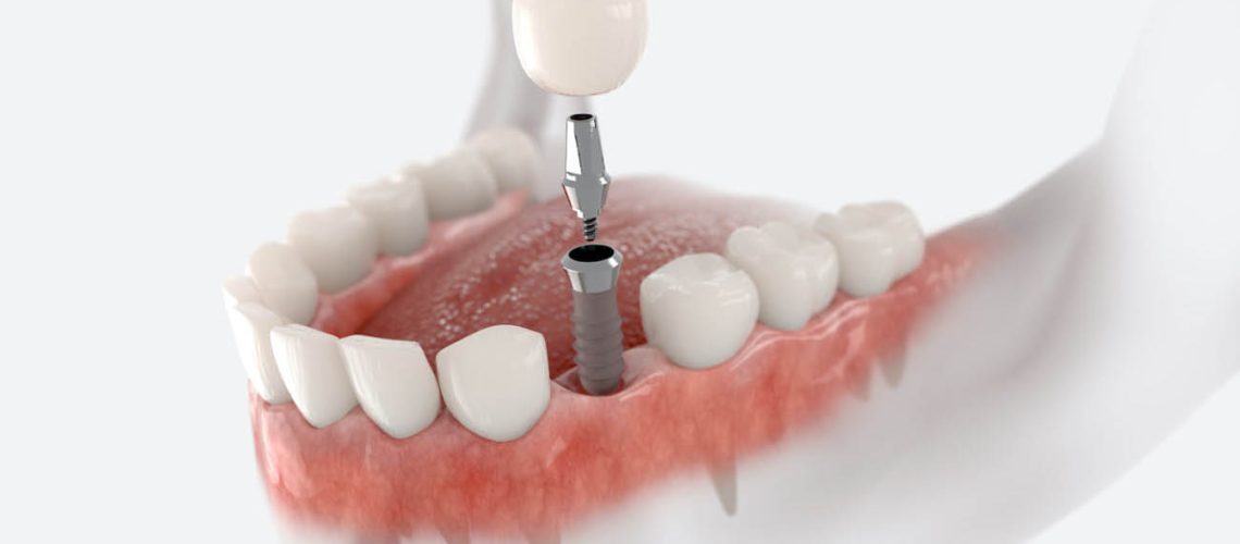 Dental crown, abutment and implant. 3D illustration of human teeth and dentures on white background.